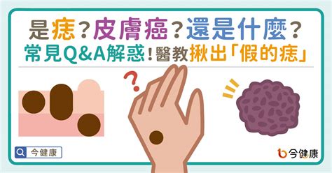 全身痣|是痣？皮膚癌？還是什麼？常見Q&A解惑！醫教揪出「。